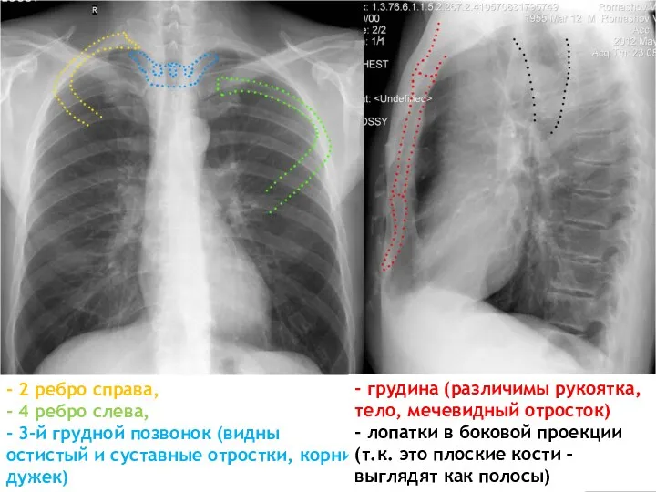 - 2 ребро справа, - 4 ребро слева, - 3-й грудной позвонок (видны