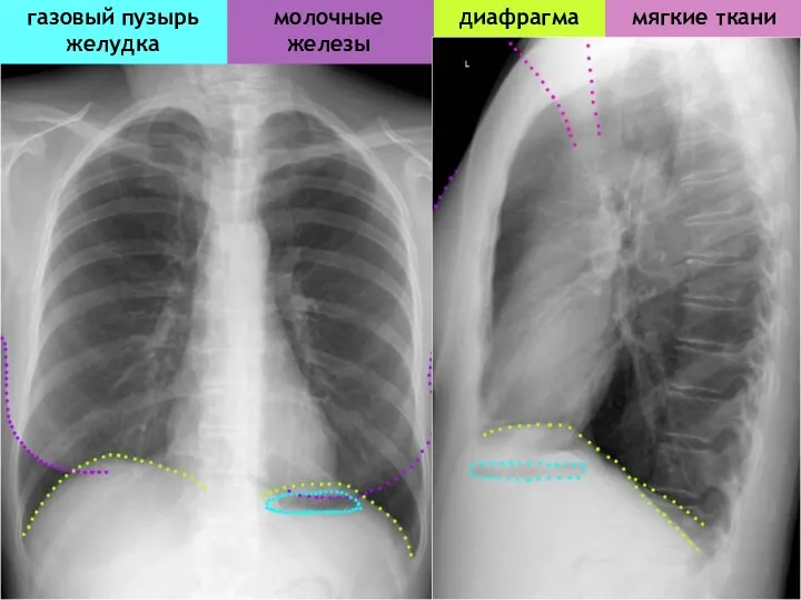 диафрагма молочные железы мягкие ткани газовый пузырь желудка