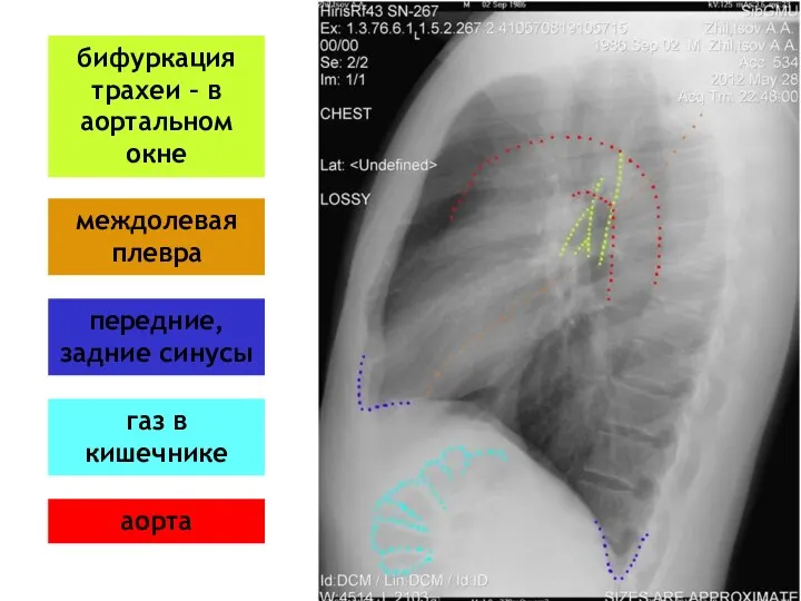 газ в кишечнике бифуркация трахеи – в аортальном окне передние, задние синусы междолевая плевра аорта
