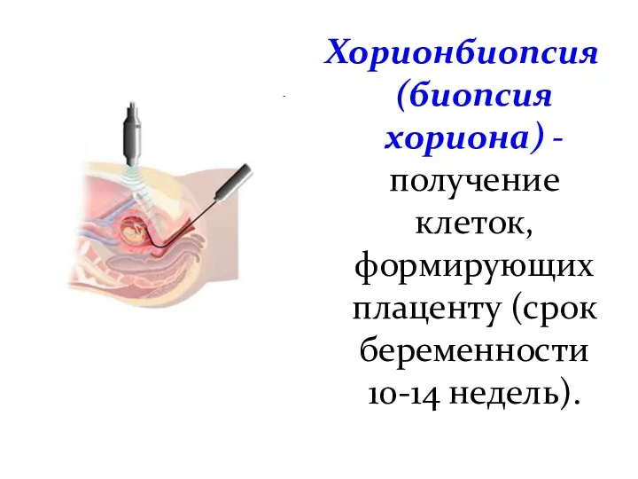 Хорионбиопсия (биопсия хориона) - получение клеток, формирующих плаценту (срок беременности 10-14 недель).
