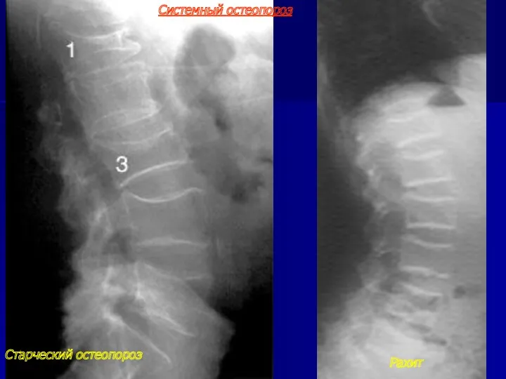 Системный остеопороз Cтарческий остеопороз Рахит