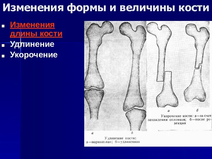 Изменения формы и величины кости Изменения длины кости Удлинение Укорочение