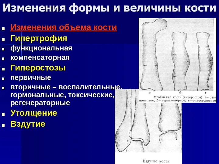 Изменения формы и величины кости Изменения объема кости Гипертрофия функциональная