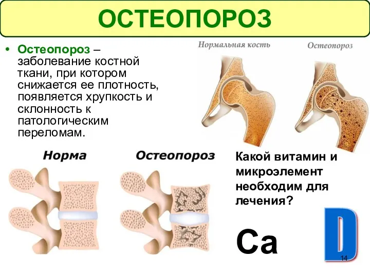 ОСТЕОПОРОЗ Остеопороз – заболевание костной ткани, при котором снижается ее