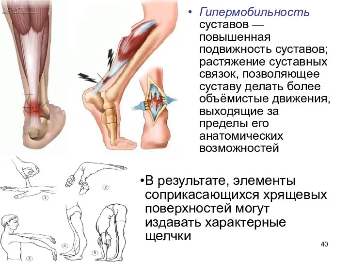 Гипермобильность суставов — повышенная подвижность суставов; растяжение суставных связок, позволяющее