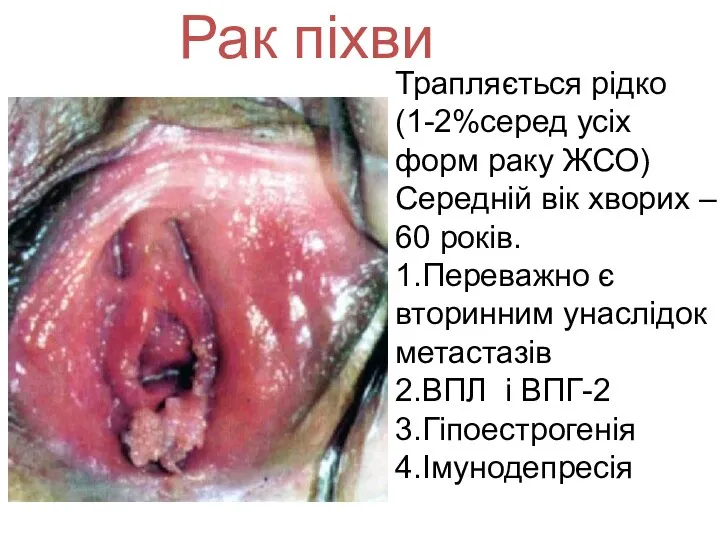 Рак піхви Трапляється рідко (1-2%серед усіх форм раку ЖСО) Середній