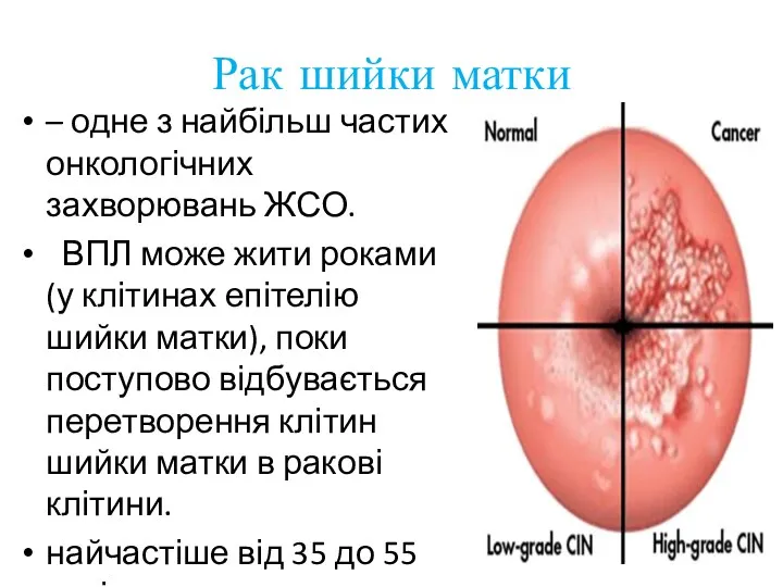 Рак шийки матки – одне з найбільш частих онкологічних захворювань