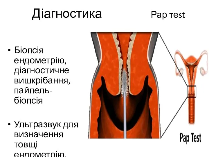 Діагностика Рар теst Біопсія ендометрію, діагностичне вишкрібання, пайпель-біопсія Ультразвук для визначення товщі ендометрію.