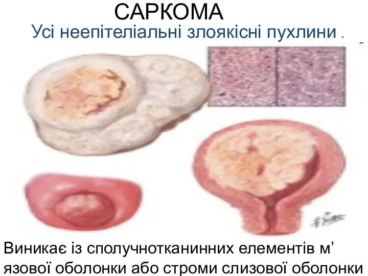 САРКОМА Усі неепітеліальні злоякісні пухлини . Виникає із сполучнотканинних елементів м’язової оболонки або строми слизової оболонки