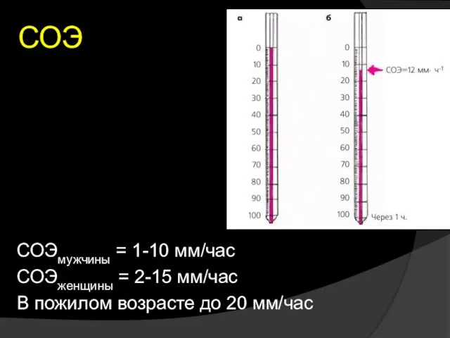 СОЭ СОЭмужчины = 1-10 мм/час СОЭженщины = 2-15 мм/час В пожилом возрасте до 20 мм/час