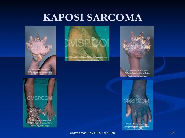 Доктор мед. наук Е.Ю.Осинцев KAPOSI SARCOMA