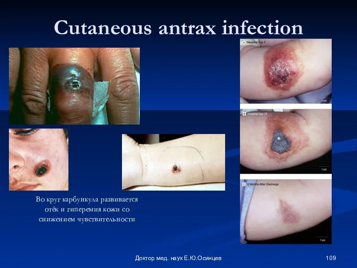 Доктор мед. наук Е.Ю.Осинцев Cutaneous antrax infection Во круг карбункула