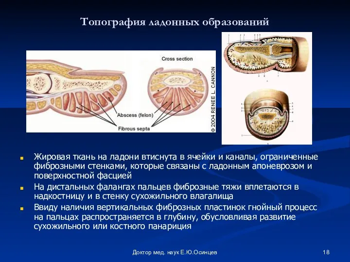 Доктор мед. наук Е.Ю.Осинцев Топография ладонных образований Жировая ткань на
