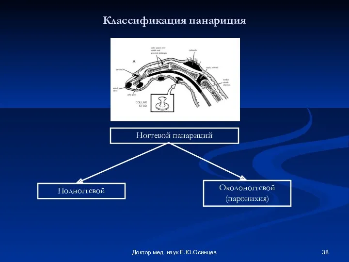 Доктор мед. наук Е.Ю.Осинцев Классификация панариция Ногтевой панариций Подногтевой Околоногтевой (паронихия)