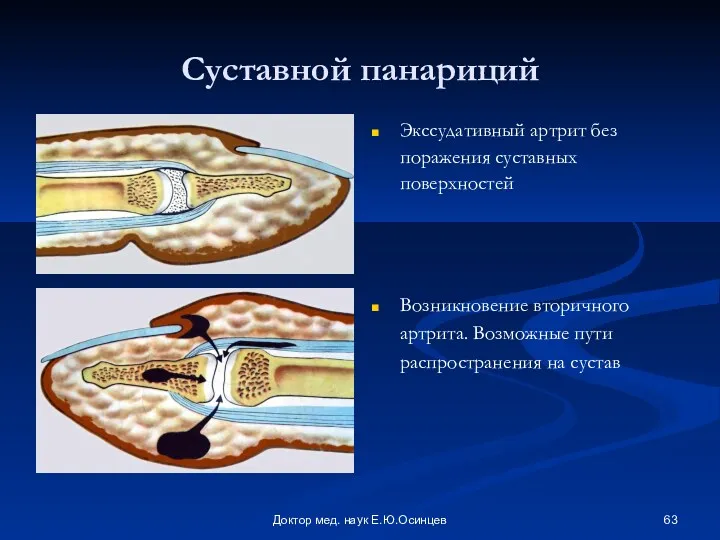 Доктор мед. наук Е.Ю.Осинцев Суставной панариций Экссудативный артрит без поражения