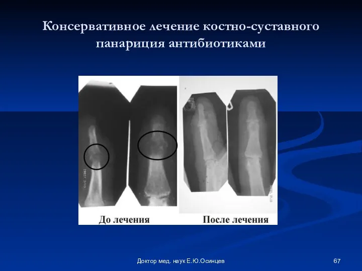 Доктор мед. наук Е.Ю.Осинцев Консервативное лечение костно-суставного панариция антибиотиками