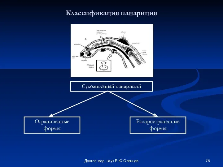 Доктор мед. наук Е.Ю.Осинцев Классификация панариция Сухожильный панариций Ограниченные формы Распространённые формы