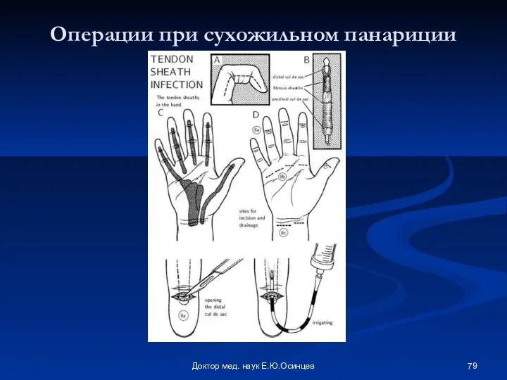 Доктор мед. наук Е.Ю.Осинцев Операции при сухожильном панариции