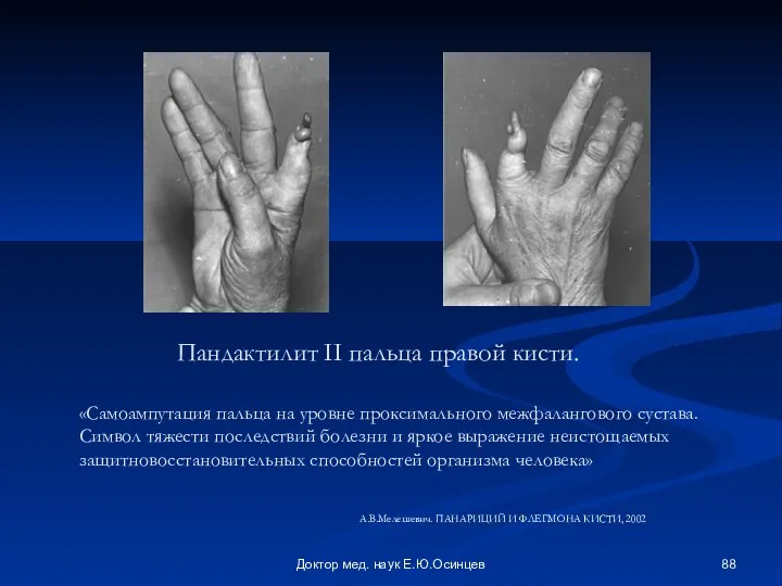 Доктор мед. наук Е.Ю.Осинцев «Самоампутация пальца на уровне проксимального межфалангового