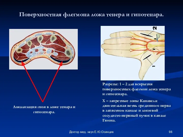 Доктор мед. наук Е.Ю.Осинцев Поверхностная флегмона ложа тенера и гипотенара.