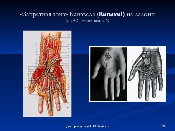Доктор мед. наук Е.Ю.Осинцев «Запретная зона» Канавела (Kanavel) на ладони (по А.С. Нарядчиковой)