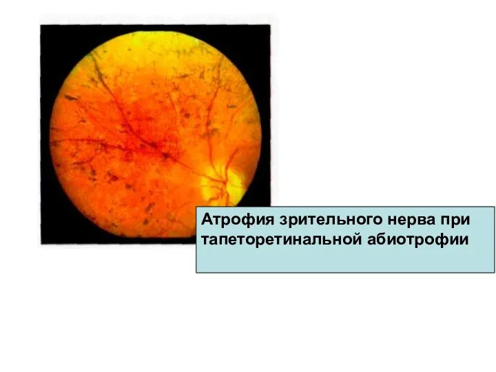 Атрофия зрительного нерва при тапеторетинальной абиотрофии