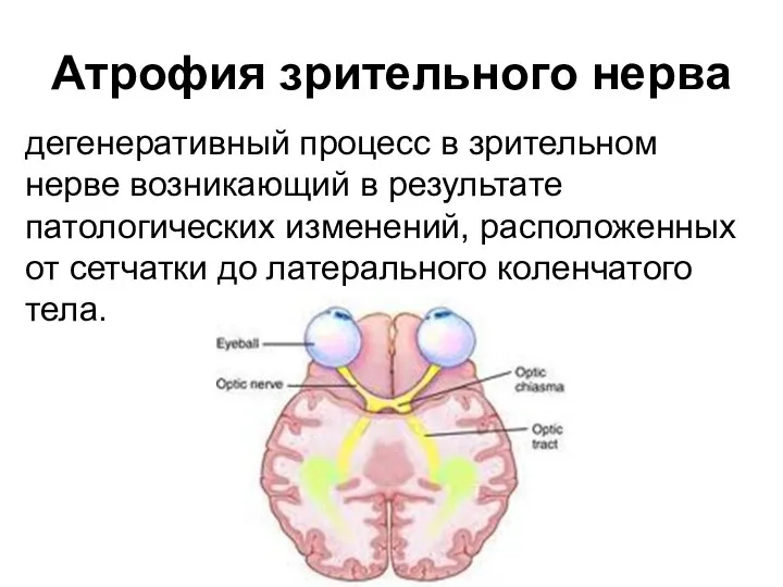 Атрофия зрительного нерва дегенеративный процесс в зрительном нерве возникающий в