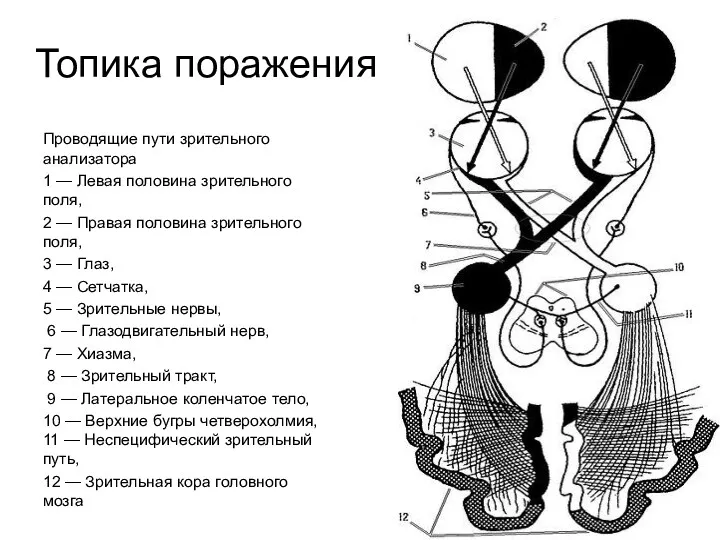 Топика поражения Проводящие пути зрительного анализатора 1 — Левая половина