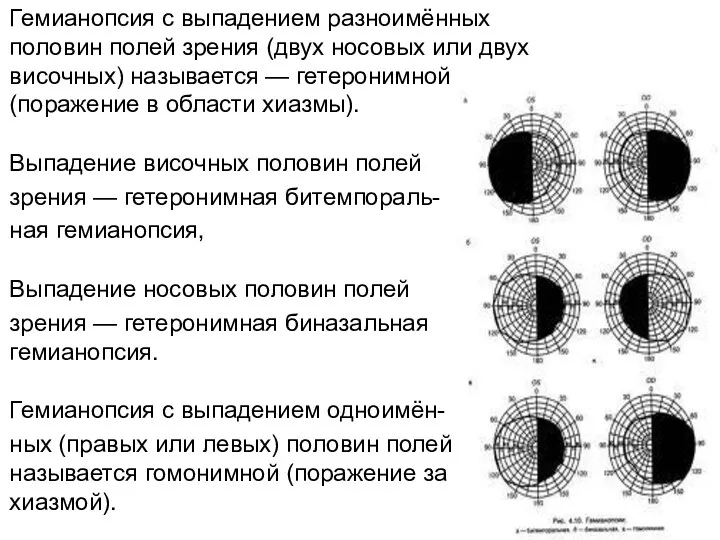 Гемианопсия с выпадением разноимённых половин полей зрения (двух носовых или