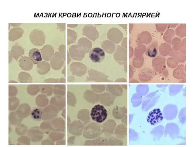 МАЗКИ КРОВИ БОЛЬНОГО МАЛЯРИЕЙ