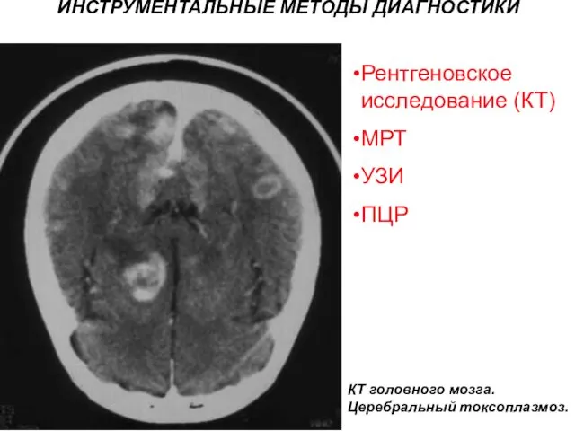 ИНСТРУМЕНТАЛЬНЫЕ МЕТОДЫ ДИАГНОСТИКИ КТ головного мозга. Церебральный токсоплазмоз. Рентгеновское исследование (КТ) МРТ УЗИ ПЦР