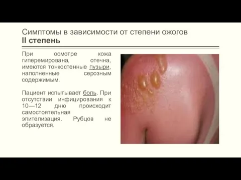 Симптомы в зависимости от степени ожогов II степень При осмотре