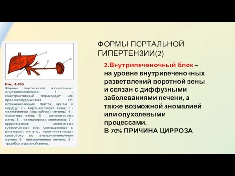 ФОРМЫ ПОРТАЛЬНОЙ ГИПЕРТЕНЗИИ(2) 2.Внутрипеченочный блок – на уровне внутрипеченочных разветвлений воротной вены и