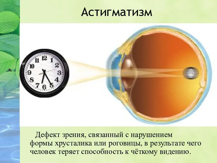 Астигматизм Дефект зрения, связанный с нарушением формы хрусталика или роговицы, в результате чего