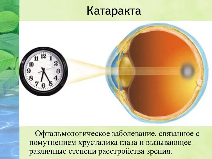Катаракта Офтальмологическое заболевание, связанное с помутнением хрусталика глаза и вызывающее различные степени расстройства зрения.