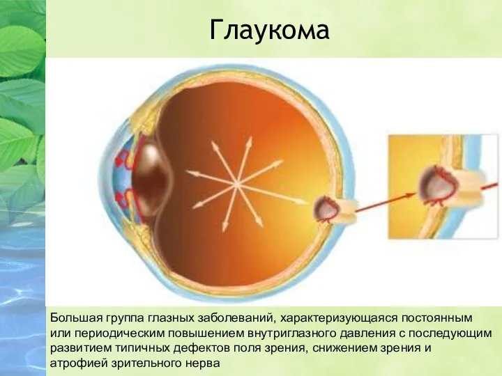 Глаукома Большая группа глазных заболеваний, характеризующаяся постоянным или периодическим повышением внутриглазного давления с