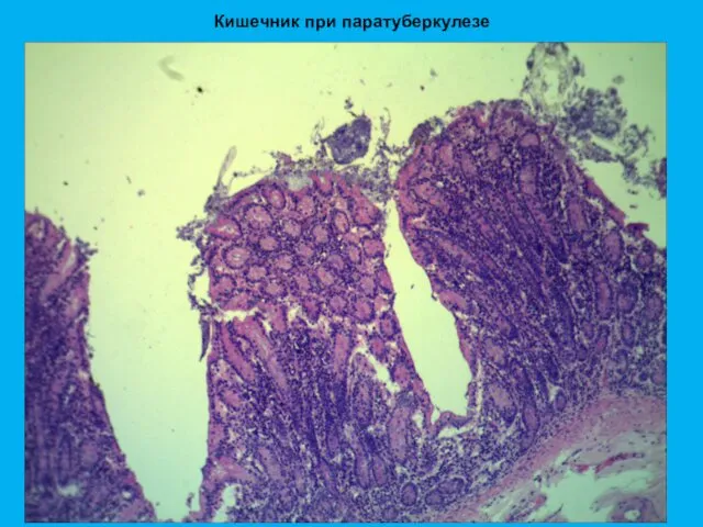 Кишечник при паратуберкулезе