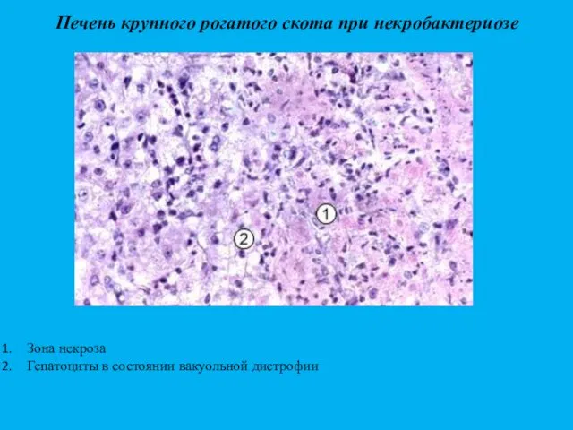 Печень крупного рогатого скота при некробактериозе Зона некроза Гепатоциты в состоянии вакуольной дистрофии