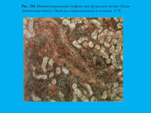 Рис. 284. Интерстициальный нефрит при бруцеллезе телят (белая пятнистая почка): Окраска гематоксилином и эозином. X 56.
