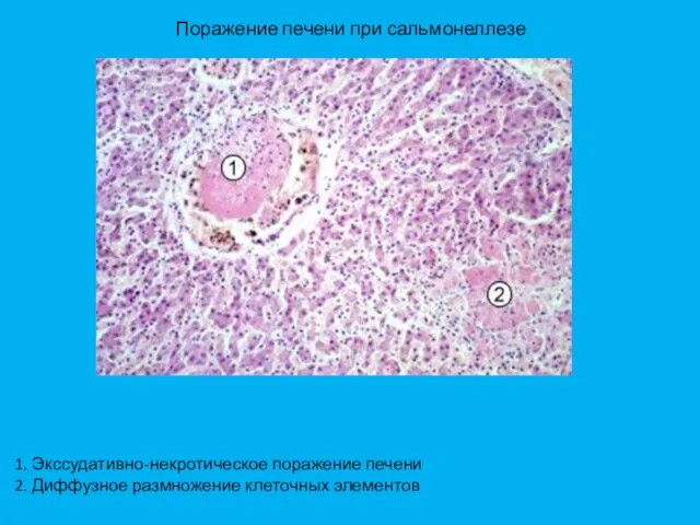 Поражение печени при сальмонеллезе 1. Экссудативно-некротическое поражение печени 2. Диффузное размножение клеточных элементов