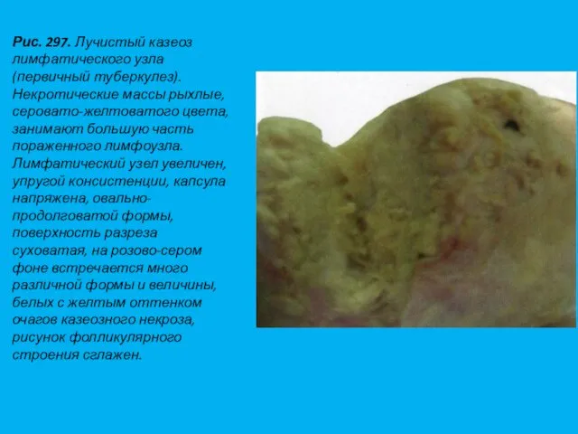 Рис. 297. Лучистый казеоз лимфатического узла (первичный туберкулез). Некротические массы рыхлые, серовато-желтоватого цвета,