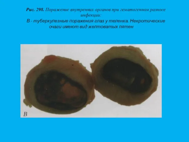 Рис. 298. Поражение внутренних органов при гематогенном разносе инфекции: В