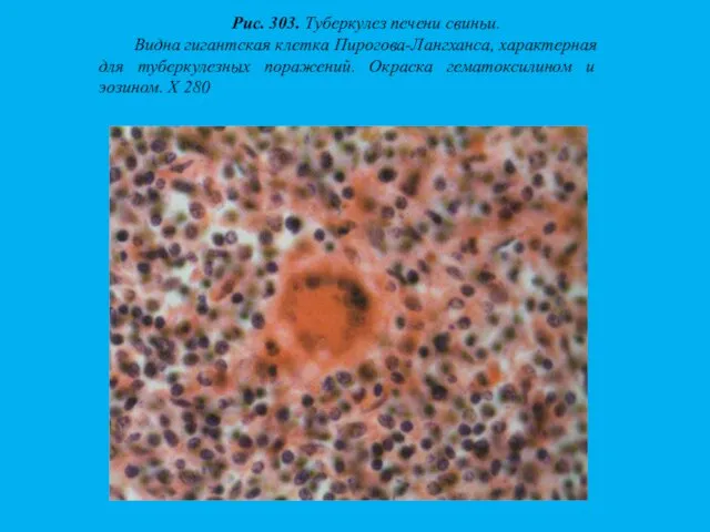 Рис. 303. Туберкулез печени свиньи. Видна гигантская клетка Пирогова-Лангханса, характерная для туберкулезных поражений.
