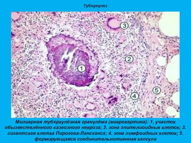Туберкулез Милиарная туберкулёзная гранулёма (микрокартина): 1. участок обызвествлённого казеозного некроза; 2. зона эпителиоидных