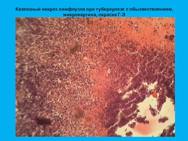 Казеозный некроз лимфоузла при туберкулезе с обызвествлением, микрокартина, окраска Г-Э