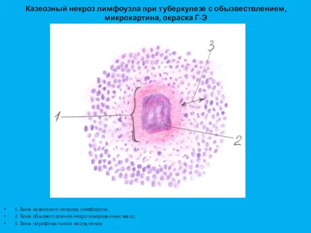 Казеозный некроз лимфоузла при туберкулезе с обызвествлением, микрокартина, окраска Г-Э 1. Зона казеозного
