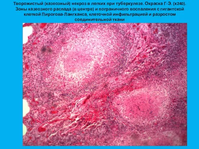 Творожистый (казеозный) некроз в легких при туберкулезе. Окраска Г-Э. (х240). Зоны казеозного распада