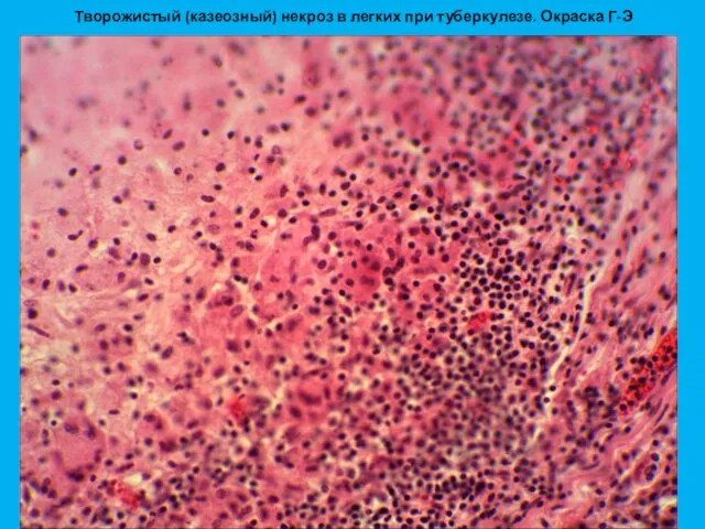 Творожистый (казеозный) некроз в легких при туберкулезе. Окраска Г-Э