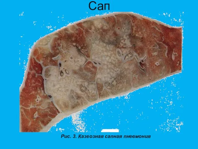 Сап Рис. 3. Казеозная сапная пневмония