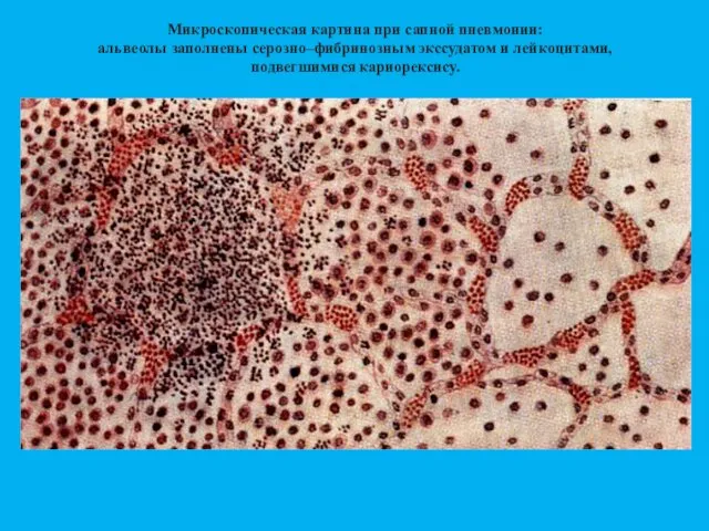 Микроскопическая картина при сапной пневмонии: альвеолы заполнены серозно–фибринозным экссудатом и лейкоцитами, подвегшимися кариорексису.